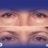 6 نصائح طبية للاستعداد لعملية شد الجفون