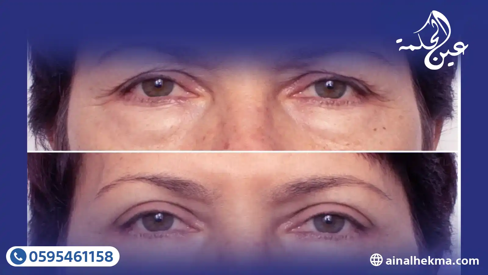 6 نصائح طبية للاستعداد لعملية شد الجفون 1 6 نصائح طبية للاستعداد لعملية شد الجفون