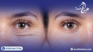 6 نصائح طبية للاستعداد لعملية شد الجفون 2 6 نصائح طبية للاستعداد لعملية شد الجفون