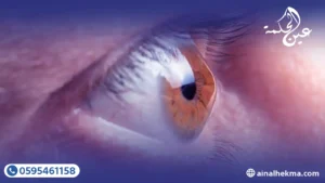 لماذا تفشل النظارات الطبية في علاج القرنية المخروطية 2 لماذا تفشل النظارات الطبية في علاج القرنية المخروطية